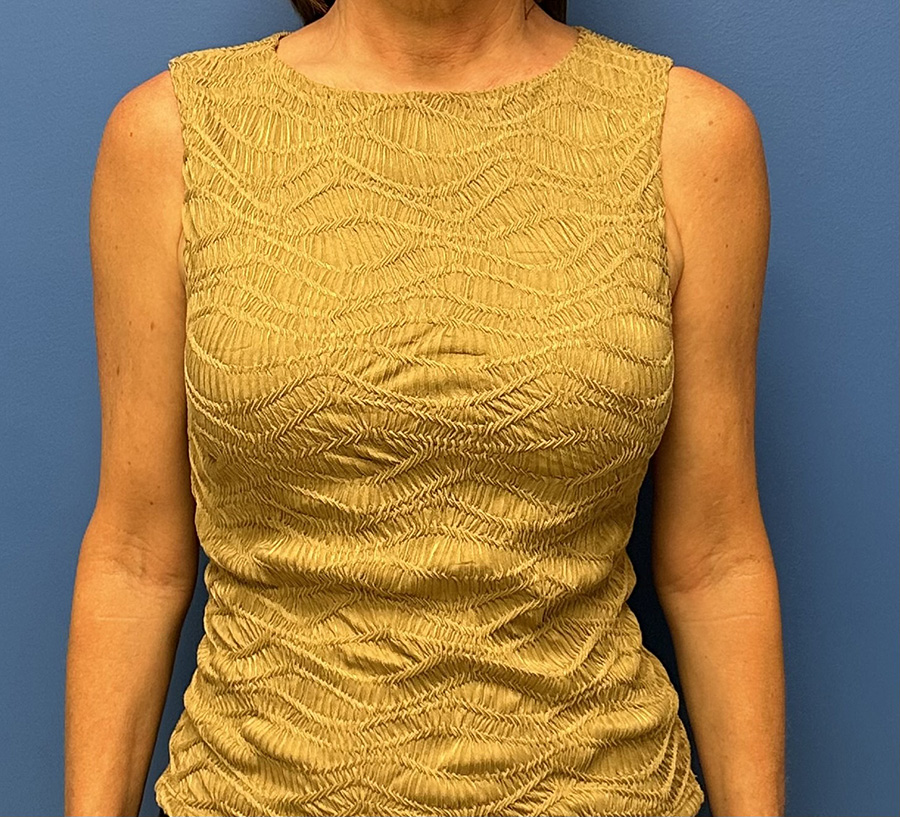 Breast Reconstruction Before and After Patient 3