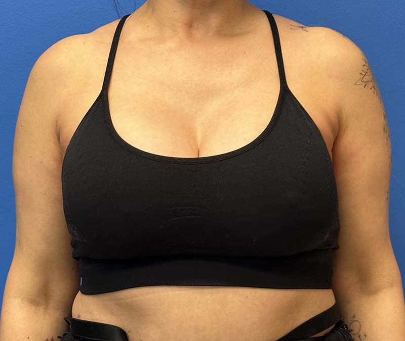 Breast Reconstruction Before and After Patient 3