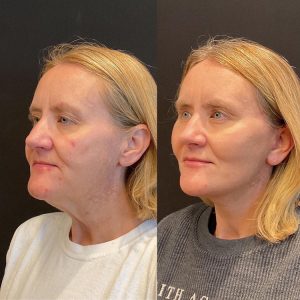 Facelift & Neck Lift Before and After Patient Thumbnail 3