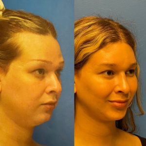Facial Feminization Before and After Patient Thumbnail 3