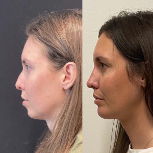 Rhinoplasty Before and After Patient Thumbnail 2