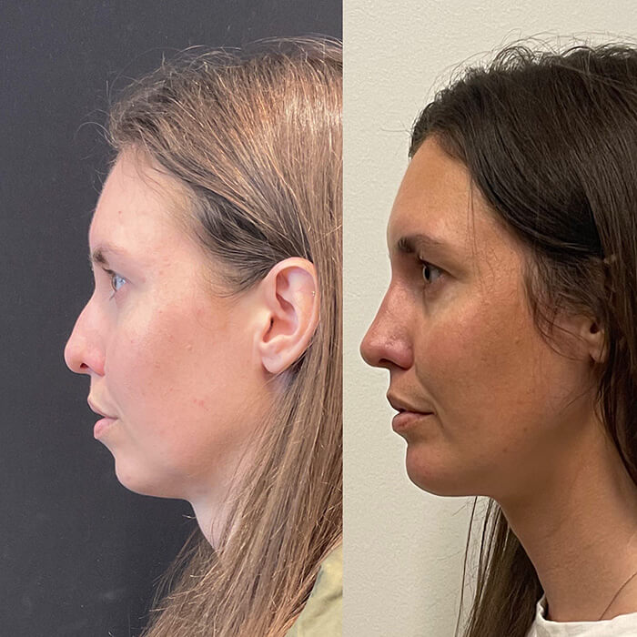 Rhinoplasty Before and After Patient 2