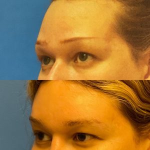 Facial Feminization Before and After Patient Thumbnail 4