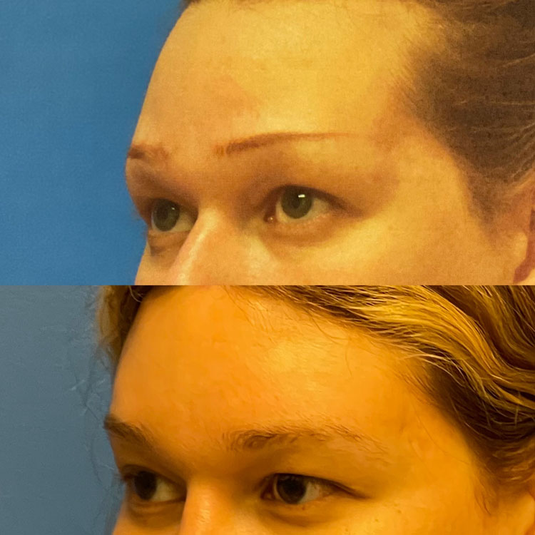 Facial Feminization Before and After Patient 4