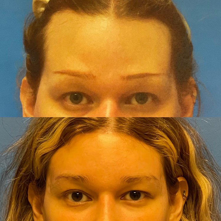 Facial Feminization Before and After Patient 5