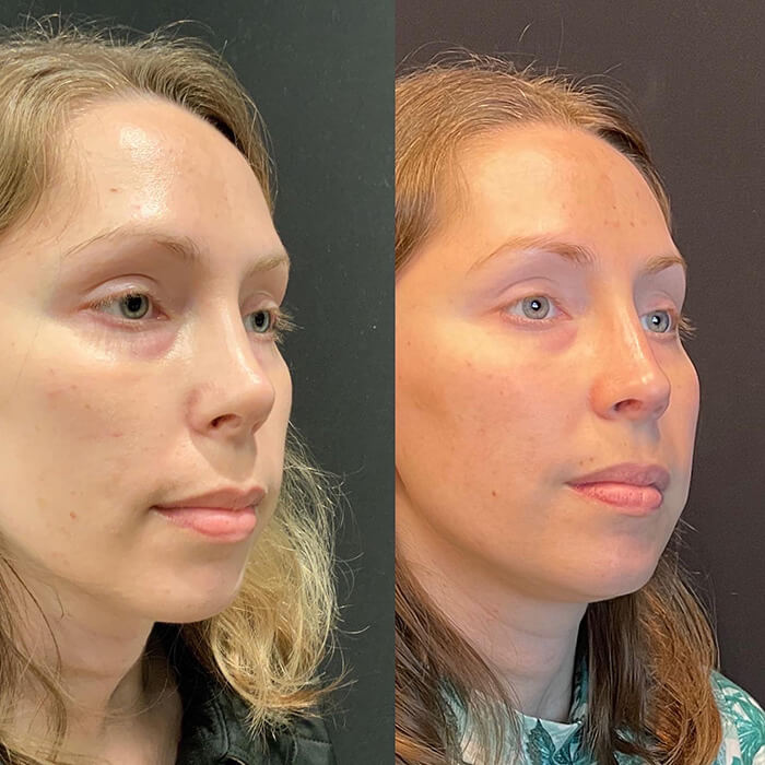 Face Before and After Patient 2