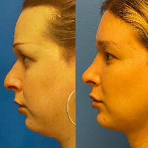 Facial Feminization Before and After Patient Thumbnail 6