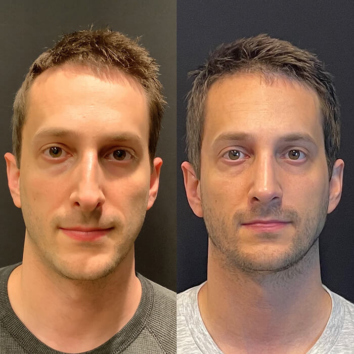 Rhinoplasty Before and After Patient 3