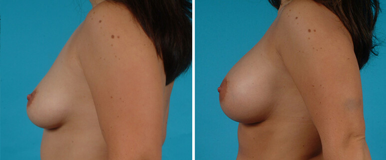 Breast Augmentation Before and After Patient 3