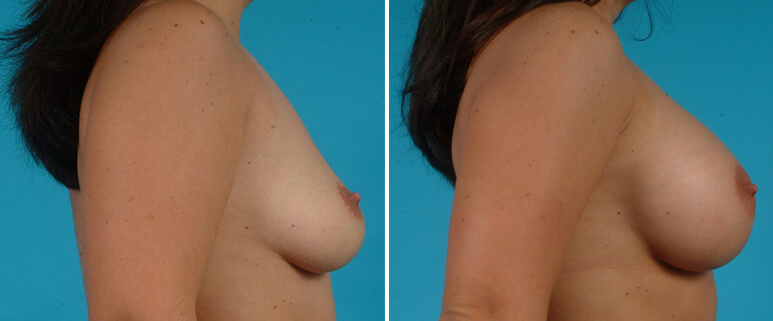 Breast Augmentation Before and After Patient 4
