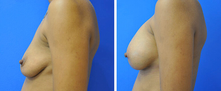 Breast Augmentation Before and After Patient 4