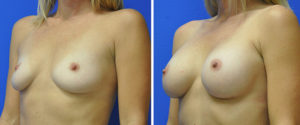 Breast Augmentation Before and After Patient Thumbnail 2