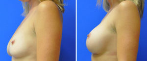 Breast Augmentation Before and After Patient Thumbnail 3