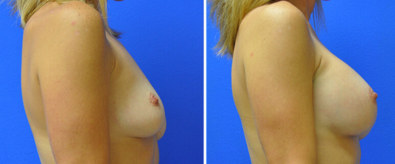 Breast Augmentation Before and After Patient 4