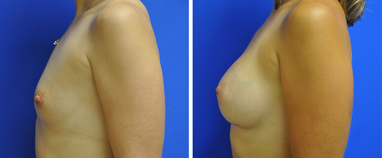 Breast Augmentation Before and After Patient 2