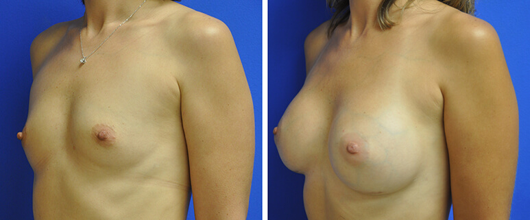 Breast Augmentation Before and After Patient 3