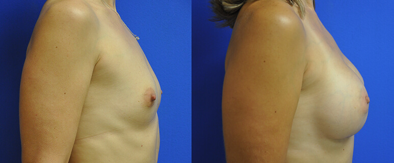 Breast Augmentation Before and After Patient 4
