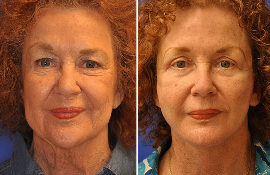 Facelift & Neck Lift Before and After Patient 2