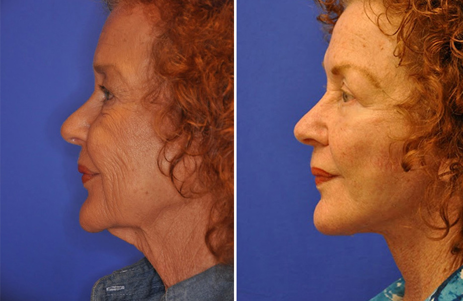 Facelift & Neck Lift Before and After Patient 1