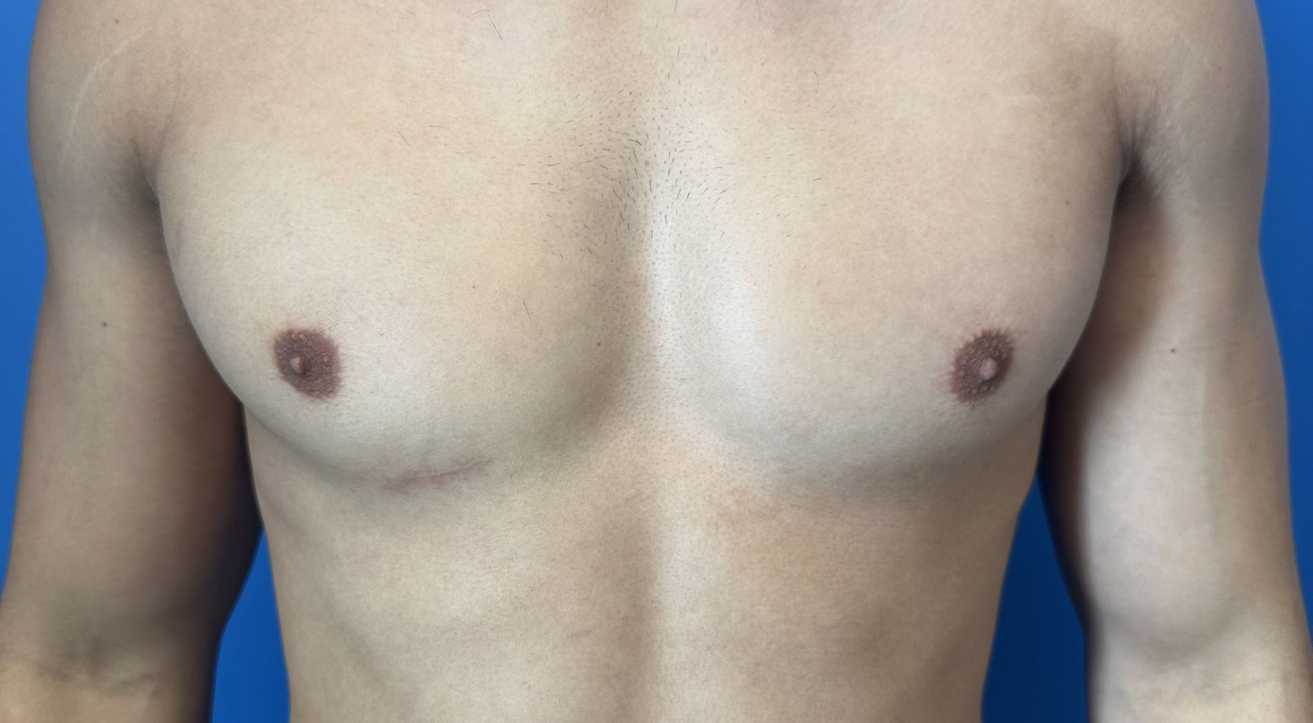 Revision Rhinoplasty Before and After Patient 1
