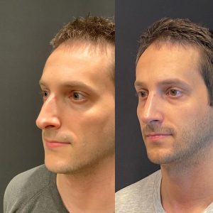 Rhinoplasty Before and After Patient Thumbnail 2
