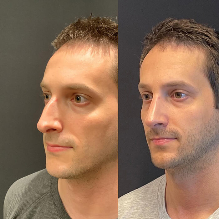Rhinoplasty Before and After Patient 2