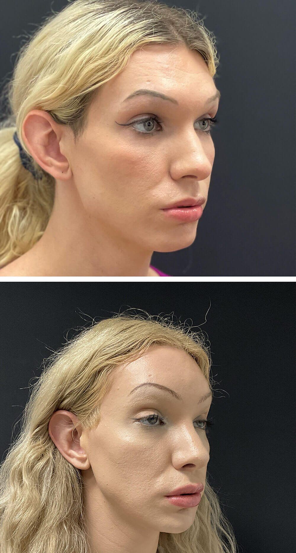 Facial Feminization Before and After Patient 2