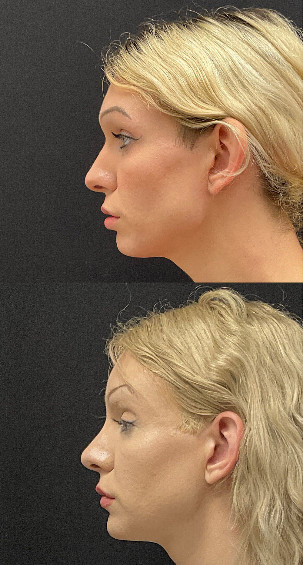 Facial Feminization Before and After Patient 3