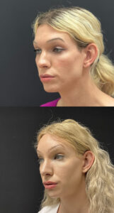 Facial Feminization Before and After Patient Thumbnail 4