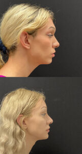 Facial Feminization Before and After Patient Thumbnail 1