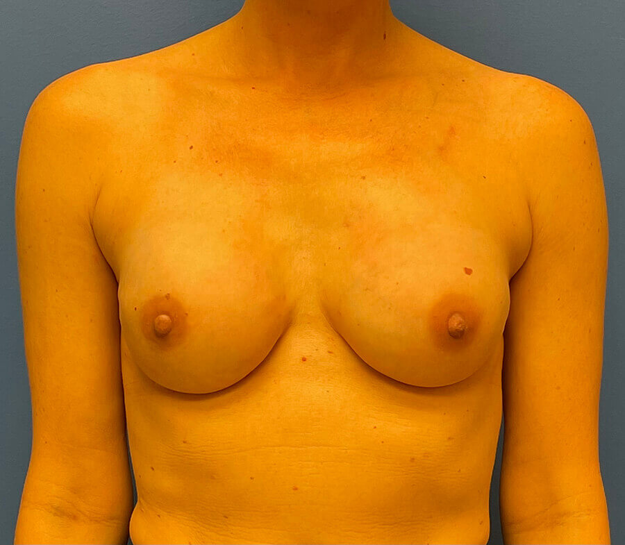 Breast Before and After Patient 1