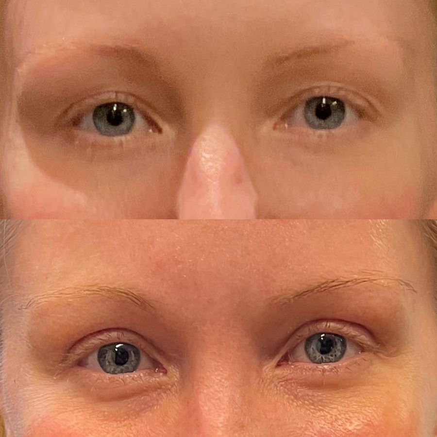 Face Before and After Patient 1