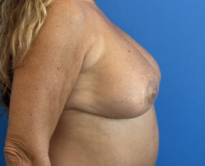 Breast Reconstruction Before and After Patient Thumbnail 3