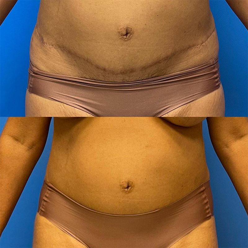 Breast Before and After Patient 3