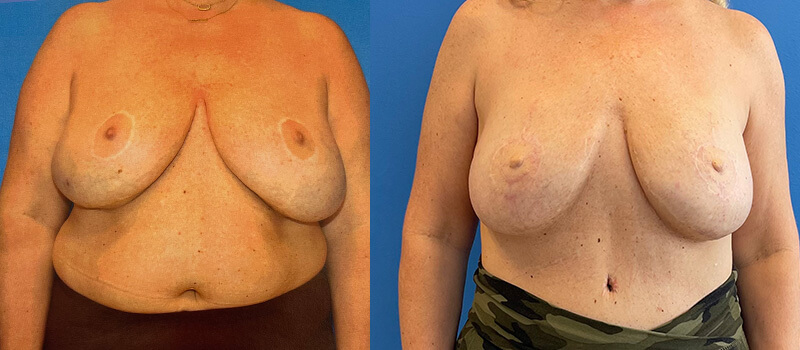 Breast Reconstruction Before and After Patient 1