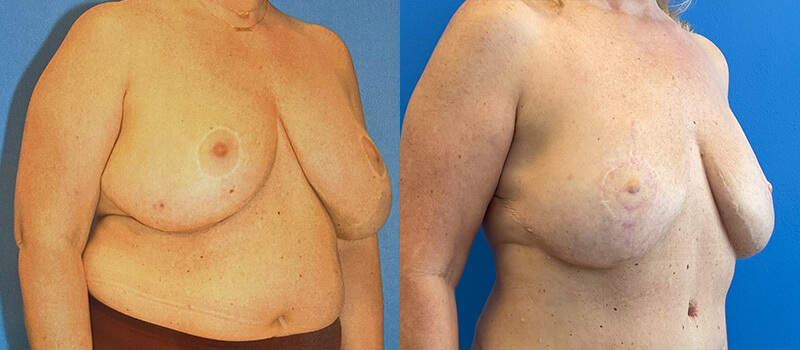 Breast Reconstruction Before and After Patient 2