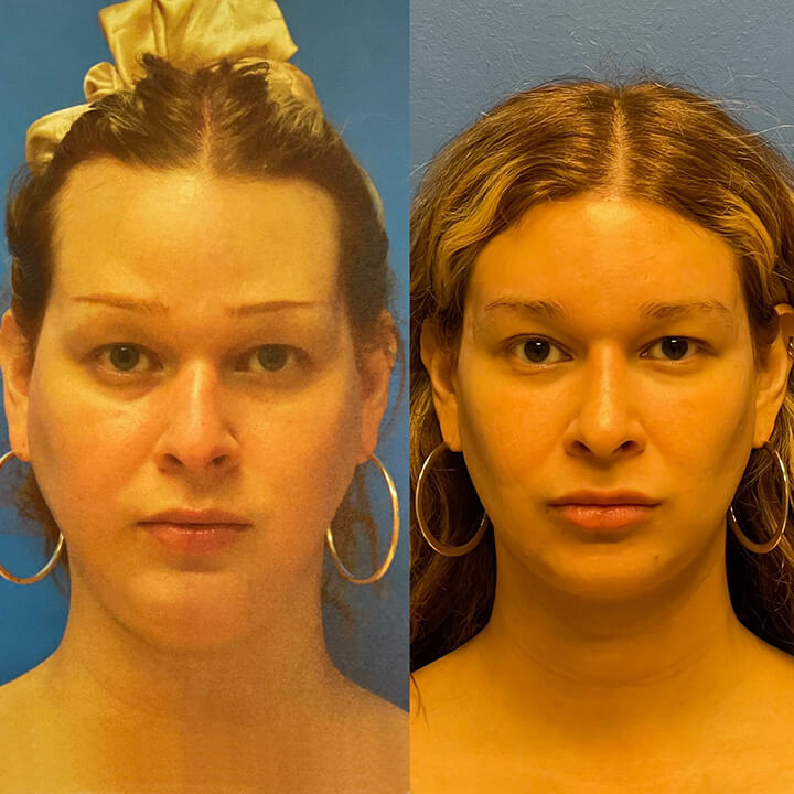 Face Before and After Patient 1