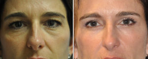 Face Before and After Patient Thumbnail 1