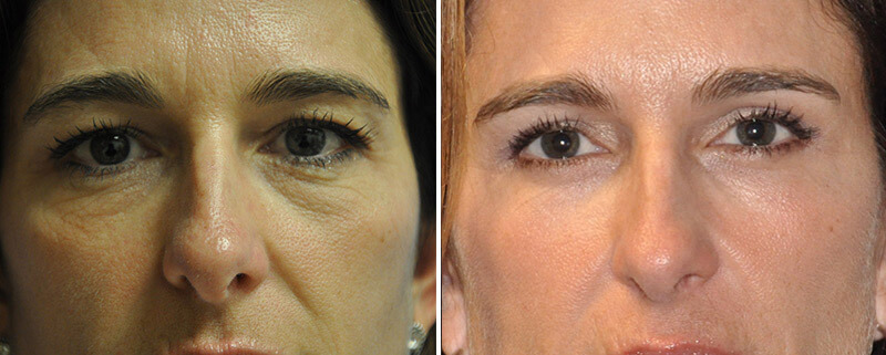 Face Before and After Patient 1