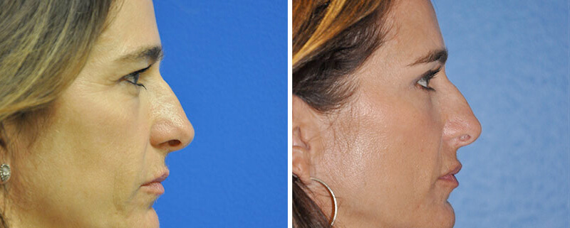 Face Before and After Patient 3