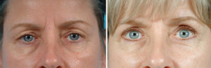 Face Before and After Patient Thumbnail 1