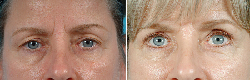 Face Before and After Patient 1