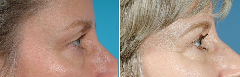 Face Before and After Patient 2