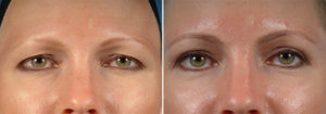 Face Before and After Patient Thumbnail 1