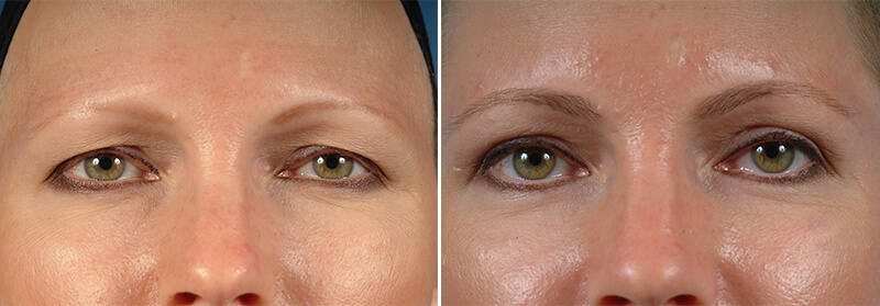 Face Before and After Patient 1