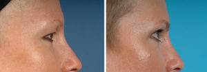 Face Before and After Patient Thumbnail 2