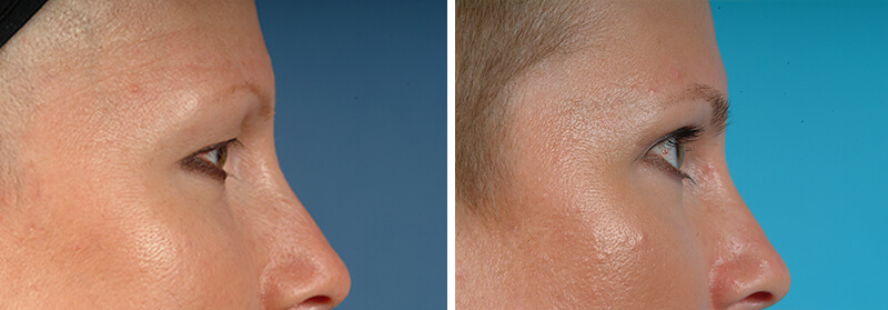 Face Before and After Patient 2