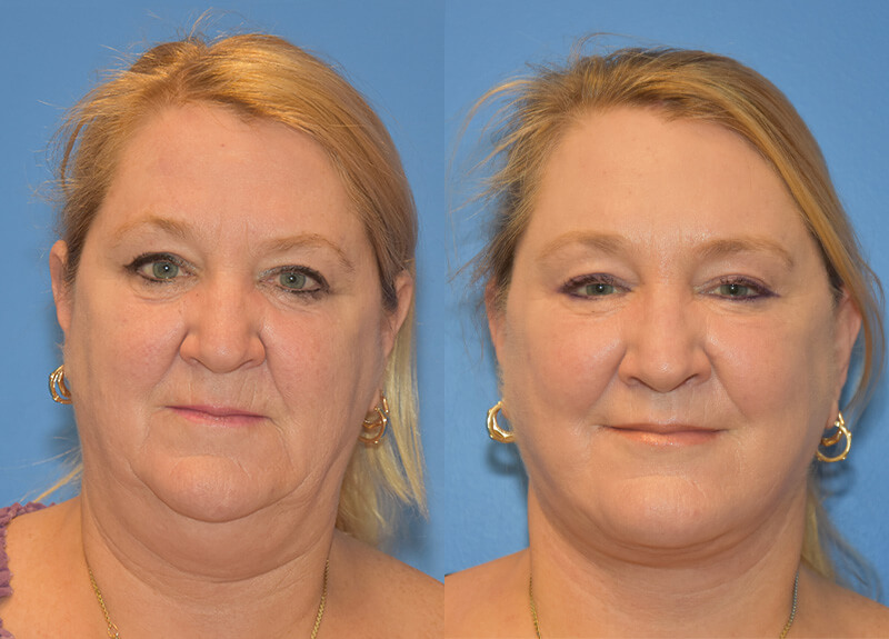 Facelift & Neck Lift Before and After Patient 1