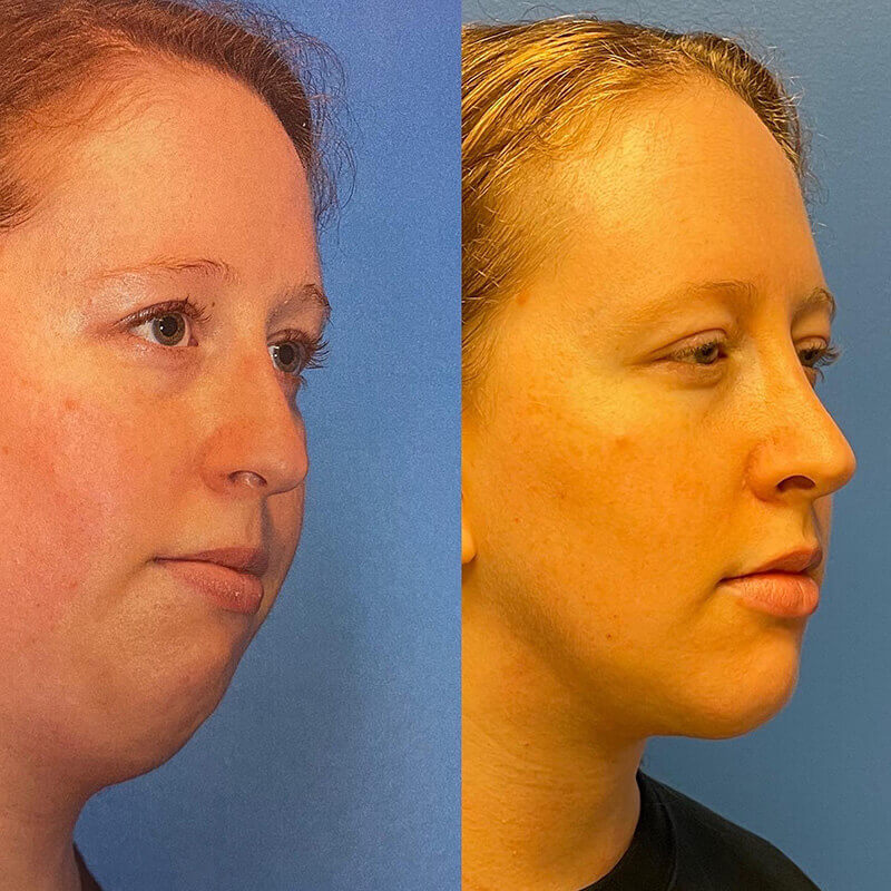 Neck Contouring Before and After Patient 2