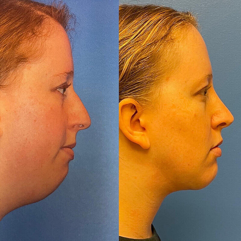 Neck Contouring Before and After Patient 3